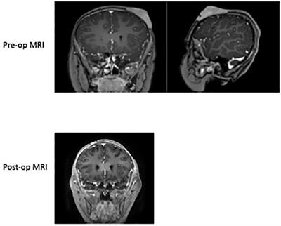 Case Report: Treatment of the rare B-cell lymphoblastic lymphoma with scalp lesion using rotation flap